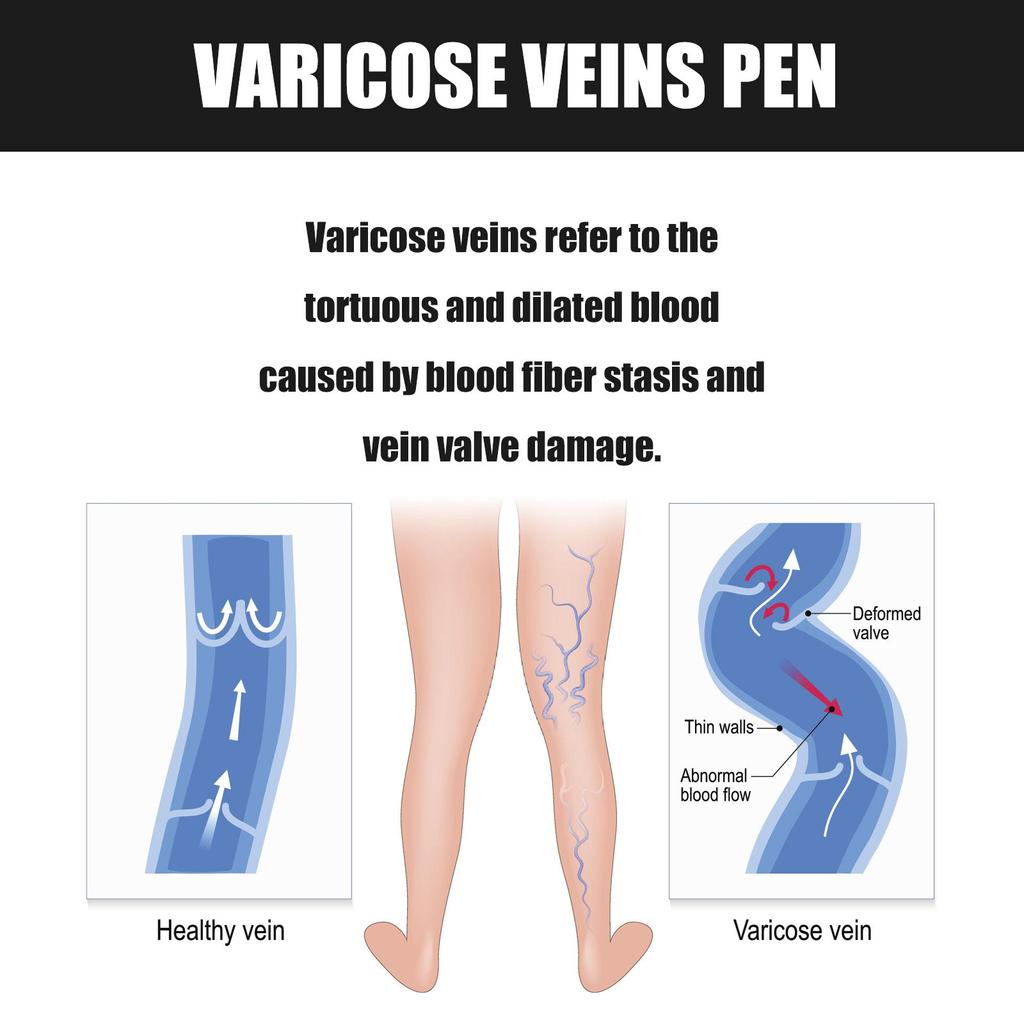 Ручка для лечения варикозного расширения вен Ручка для снятия дискомфорта при вздутии ног Ручка для расслабления ног Ручка для абажурной терапии Ручка для восстановления ног