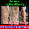 Solution To Soothe Varicose Vein Discomfort In Your Legs