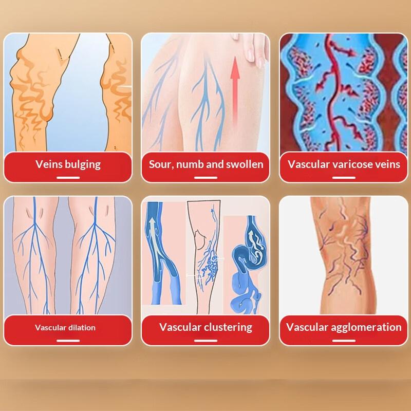 Varicose Vein Cream for Leg Swelling & Circulation