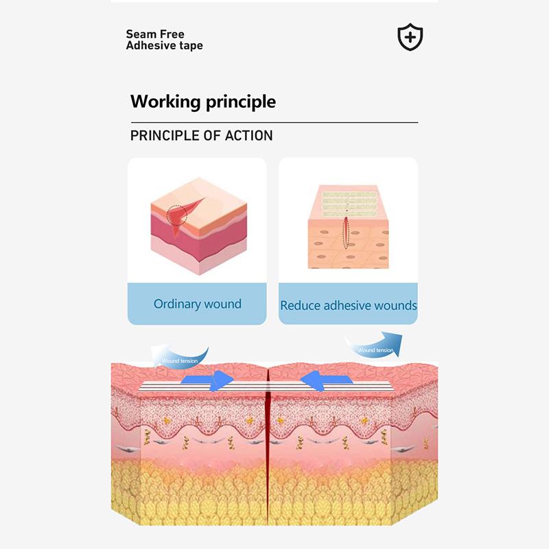 Полоски для закрытия ран Хирургические швы Послеродовое лечение ран Косметическая хирургия Клей Медицинское здравоохранение