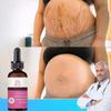 Powerful Stretch Mark Remover Essential Oil Pregnancy Marks Scar Removal Maternity Smooth Skin Body Repair Cream