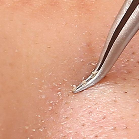 Инструмент для удаления угрей из нержавеющей стали, прыщей, прыщей, пятен, комедонов