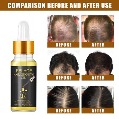 Fast Hair Growth Serum Hair Regrowth Essential Oil Anti Hair Loss Repair Damaged Scalp Women Men Anti Baldness Hair Growth Care