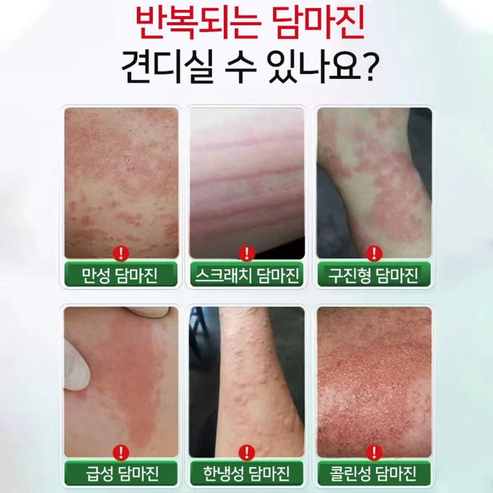 Dermatitis Eczema Urticaria Itching Ointment YZ-XMZ03, 30g, 1 Unit