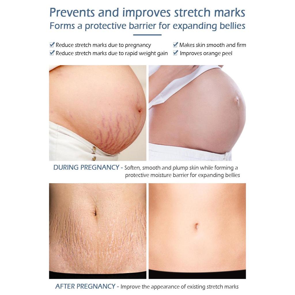 VIBRANT GLAMOUR Крем для удаления растяжек, набор кремов для ремонта тела, шрамы для беременных, линии ожирения, шрамы, антивозрастной укрепляющий уход за кожей, 2 шт.