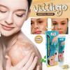 ZB Powerful Cream Treatment for Vitiligo and Skin Discoloration Reduce White Spots, Improve Skin Pigmentation