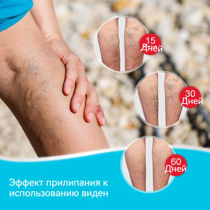 Китайский травяной пластырь для вен для улучшения здоровья капилляров Эффективный пластырь L для вен