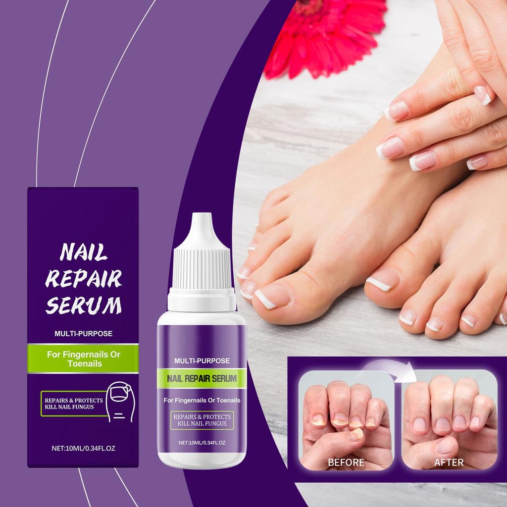 Nail Care Solution Deeply Nourishes Nails, Enhances Toughness, Reduces Breakage, Repairs Damage And Promotes Nail Growth.10ML