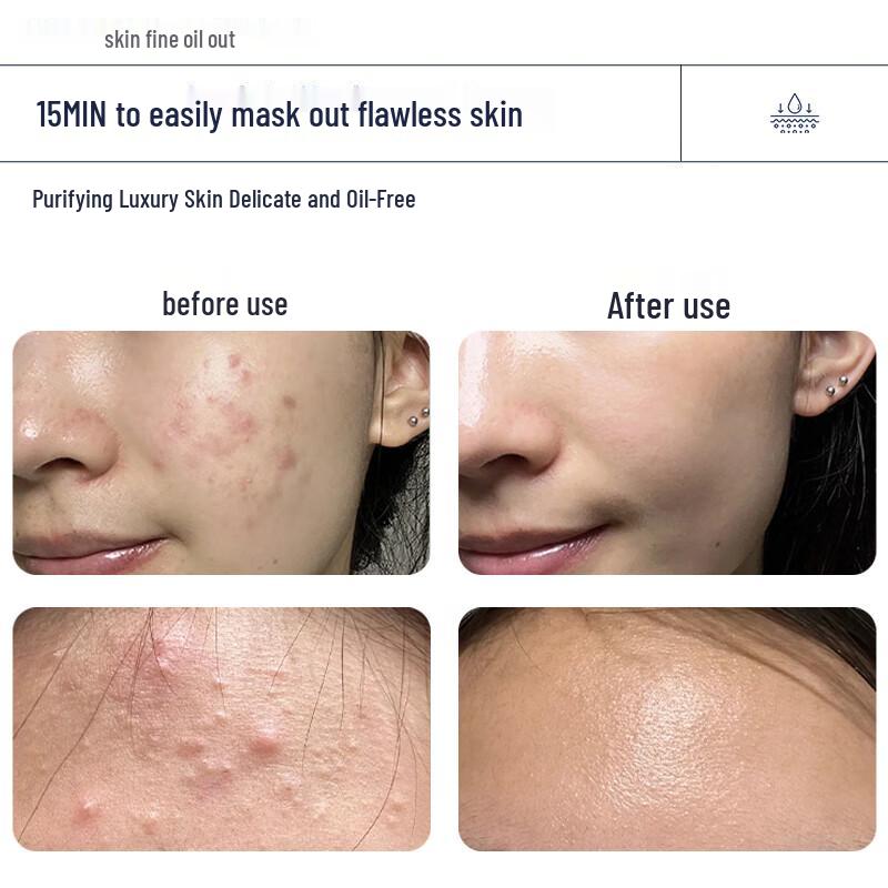 Маска Naseki с салициловой кислотой для очищения пор и от акне