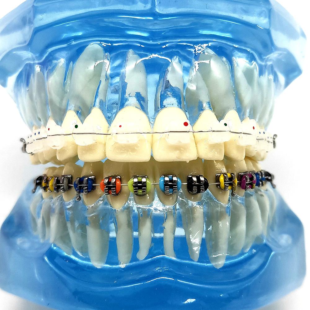 1 шт., стоматологическая ортодонтическая модель, связь с пациентом, 2 вида брекетов с дугами, лигатуры, керамический брекет, металлический краевой брекет