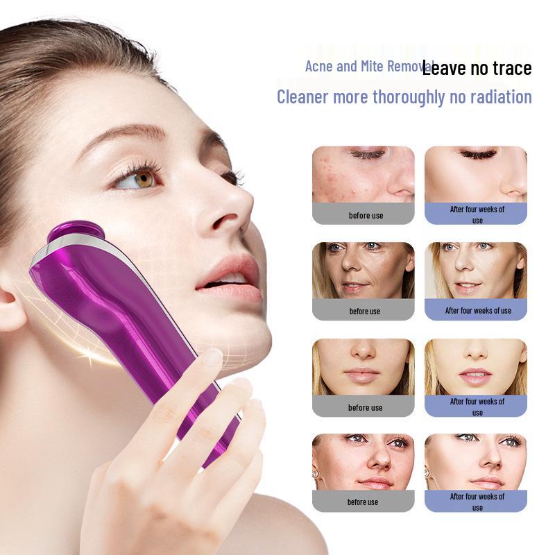 Озоновая плазма для удаления акне и стерилизации, косметический прибор: Омолаживает, подтягивает и восстанавливает кожу лица, при этом уничтожая клещей для домашнего использования.