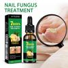 7Days Nail Fungus Treatment Serum Ginger  All Plant Anti-infective Paronychia Onychomycosis Toe Foot Nail Fungal Repair Gel Hand Foot Care