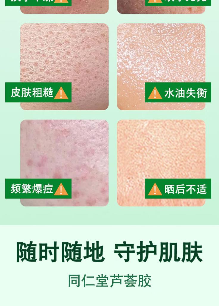 Beijing Tongrentang Aloe Vera Gel for Acne Removing, Moisturizing, Oil Controlling and Soothing gel for Acne Removing and Acne Alleviating