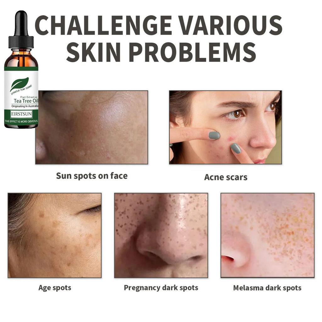 5 мл/15 мл/30 мл/50 мл/натуральное масло чайного дерева, увлажняющее, для лица, тела, женский уход за кожей, восстановление кожи, увлажняющее, ароматерапия, чистое массажное эфирное масло