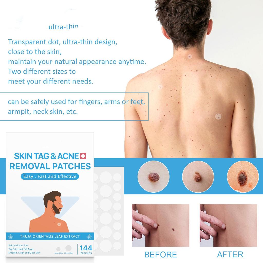 Acne Patches (144 Pcs) Hydrocolloid Acne Patches With Salicylic Acne Patches Pimple Patches Patches Face And Skin Stickers