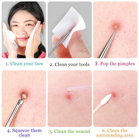 Набор инструментов для удаления черных точек Профессиональный экстрактор черных точек с футляром и 5-кратным увеличительным стеклом для удаления прыщей, черных точек, прыщей, лба, лица, носа