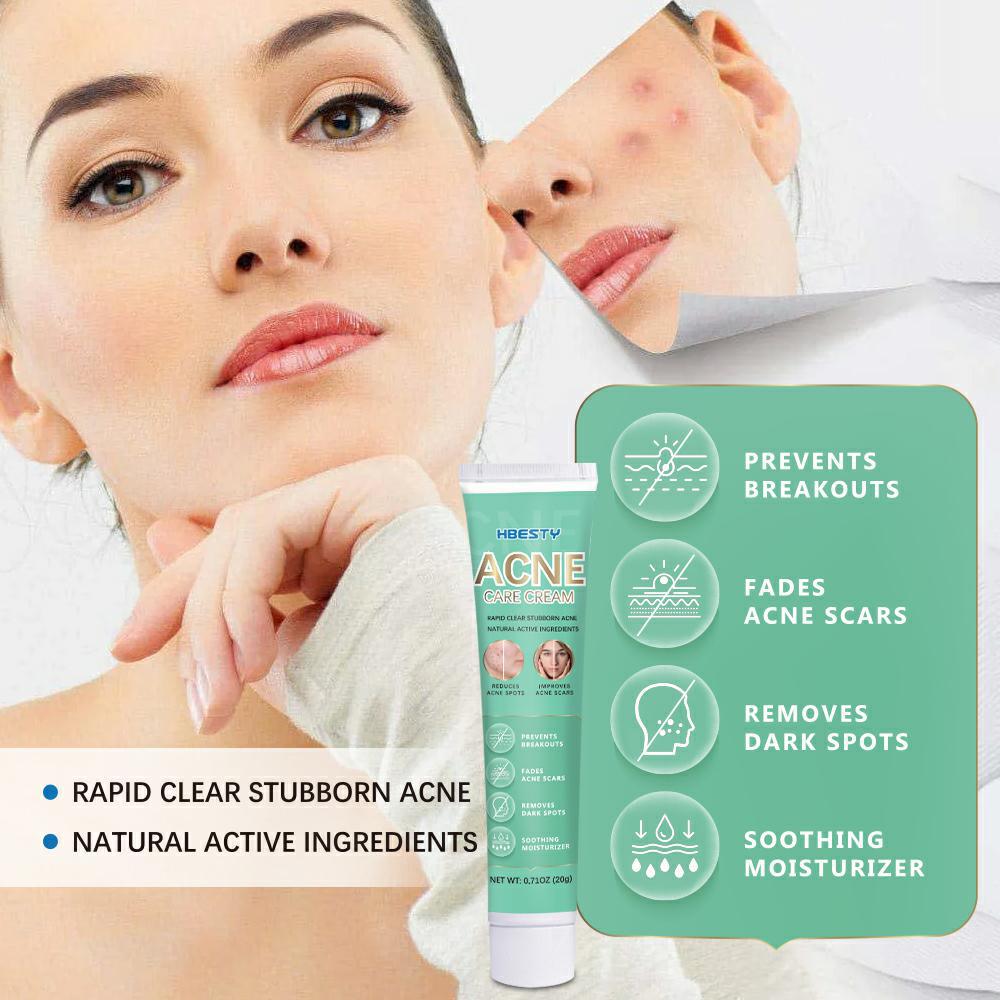 Эффективный крем для удаления прыщей, алоэ, пятна от прыщей, контроль масла, антивозрастной, увлажняющий, отбеливающий крем от прыщей, уход за кожей, 20 г