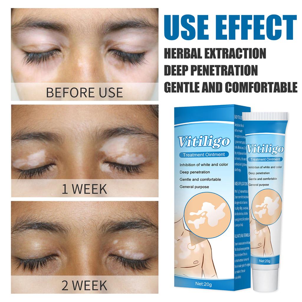 White Spot Piebald Cream Vitiligo Ointment Herbal Sweat Spot Cream Body Skin Care