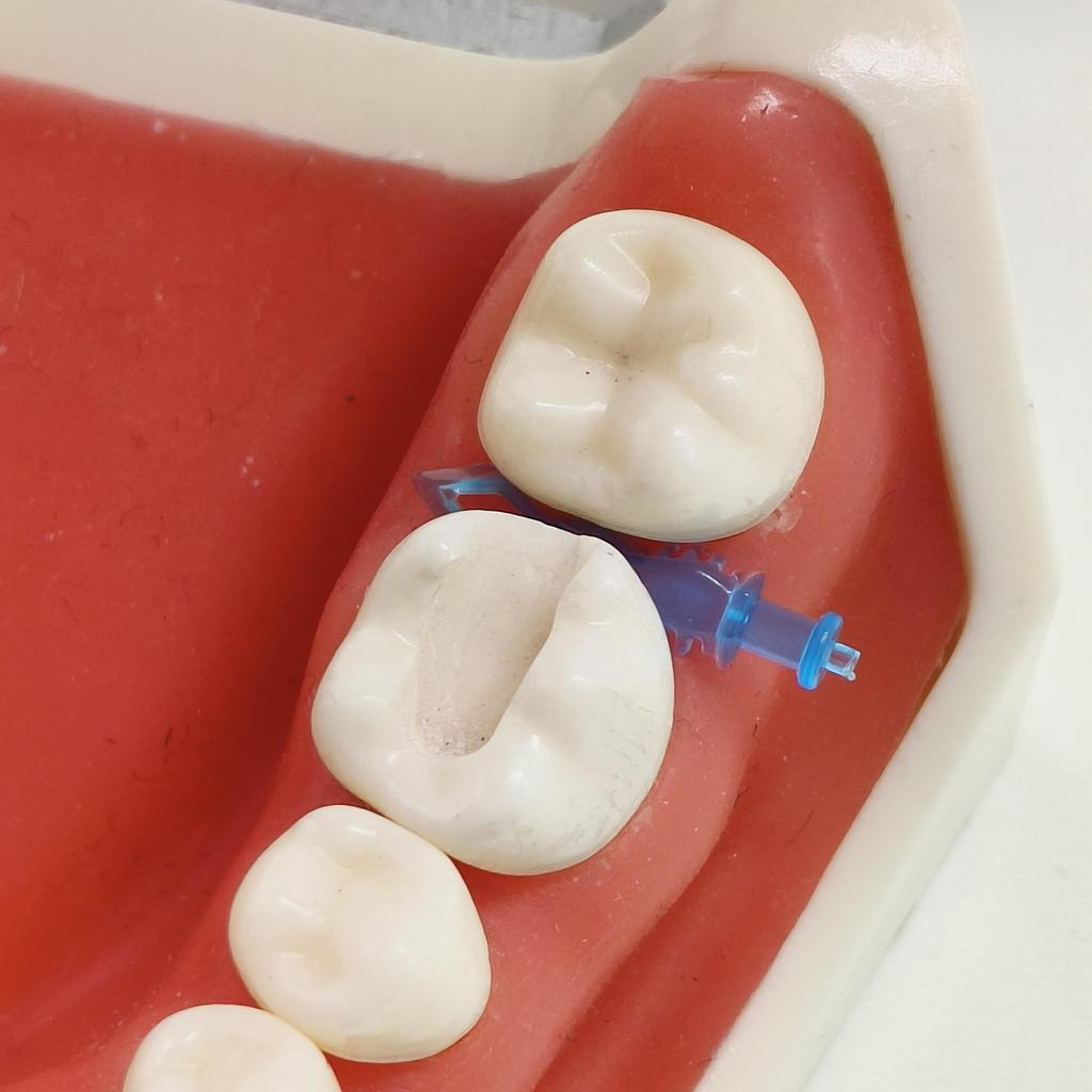 1 пакет (150pcs / уп) Dental Clear Matrix BT Прозрачные матрицы Передние зубы PosteriorFit Bioclear Зубы Молярная дуга Класс Реставрация Черный Треугольник