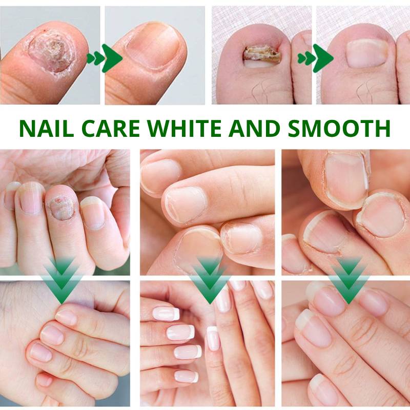 Nail Care Essence Сыворотка для отбеливания ногтей
