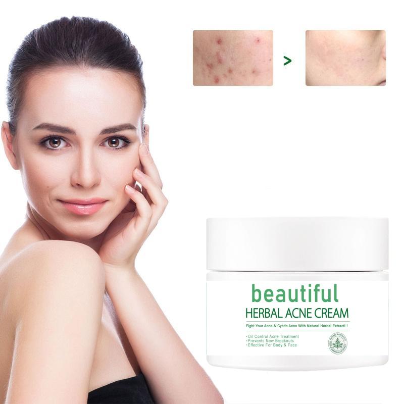 Acne Removing Cream, Acne Removing, Male and Female Students Fade Acne Marks, Acne Scar Removing Cream, Acne Pit Repairing