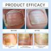 Onychomycosis Care Toenail Soft Nail Thickening Nail Granulation Nail Liquid15ml