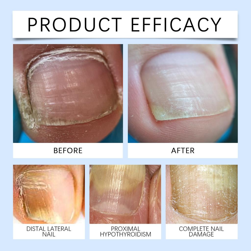 Onychomycosis Care Toenail Soft Nail Thickening Nail Granulation Nail Liquid15ml