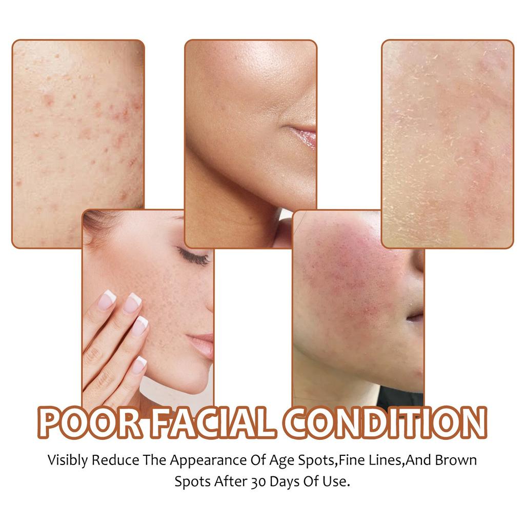 Lemon Kojic Soap Kojic Soap For Hyperpigmentation For Dark Dot Kojic  Dark Dot Remover Soap Face Body Wash Hand Bath Soap Bars Face Cleanser 100g