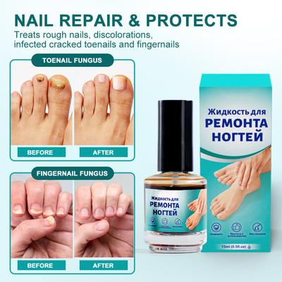 Онихомикоз Жидкость Набор для ухода за ногтями 15 мл