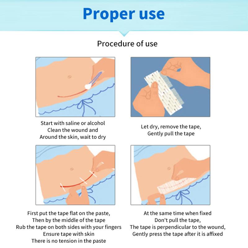 Стерильная полоска для удаления шрамов, следов от угревой сыпи, стерильный пластырь для первой помощи, дорожный хирургический пластырь для закрытия ран