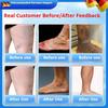 Clinically Tested Vein Cream | Reduces Swelling & Discomfort from Varicose Veins