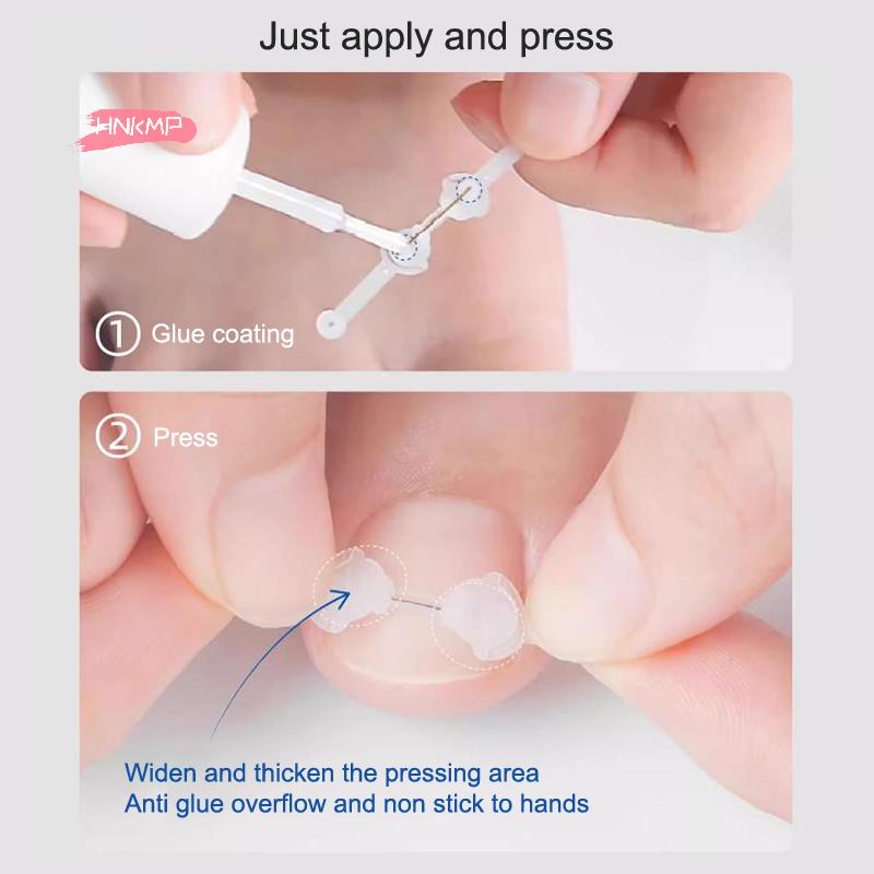 Инструмент для коррекции вросшего ногтя с эластичной наклейкой-пластырем, выпрямляющим зажимом-скобой - Средство для лечения ногтей на ногах, Педикюрное решение