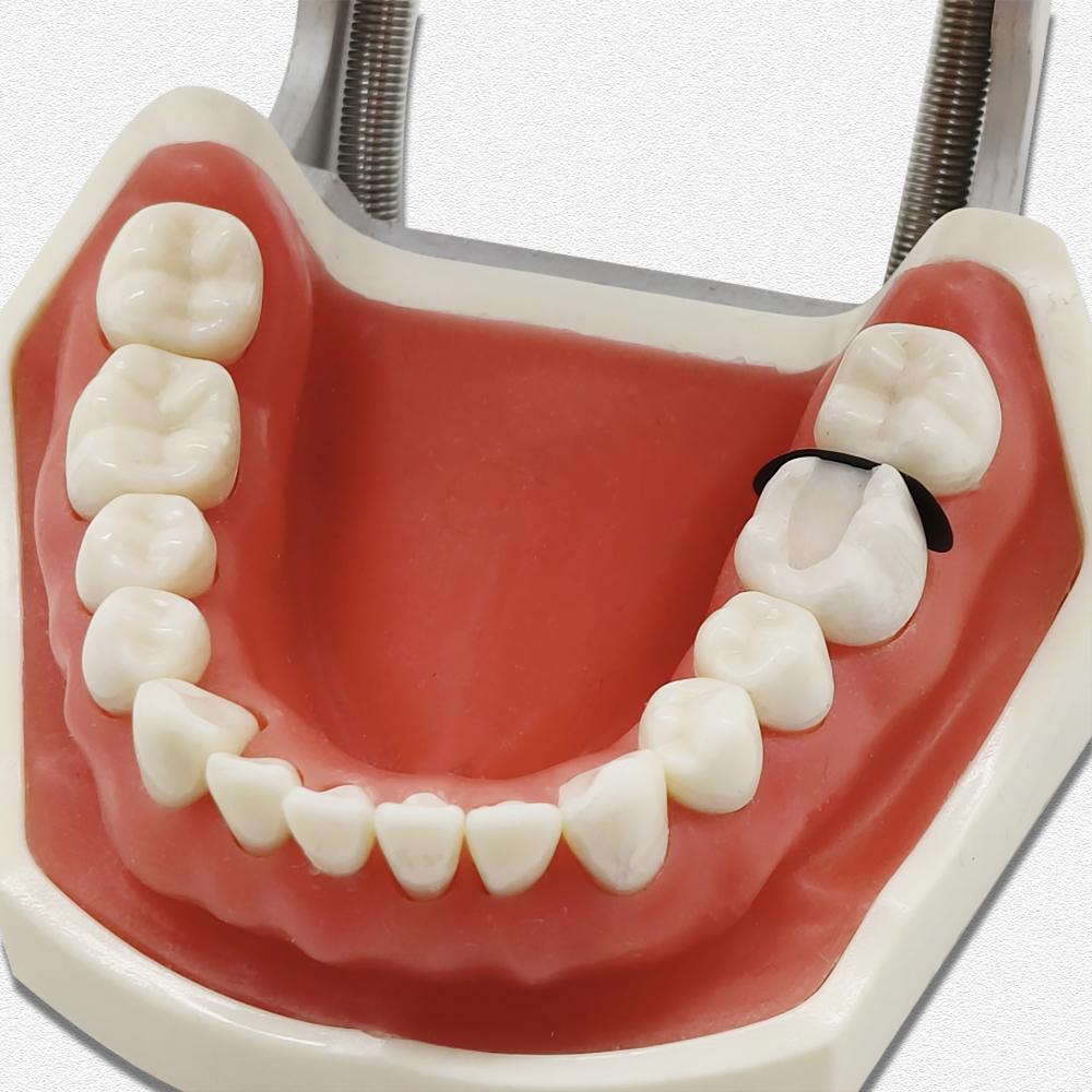 Dental Sectional Contoured Matrices Black Coated Matrix Matrix Bands Tofflemire S/M/L Stuck Dental Lab Material