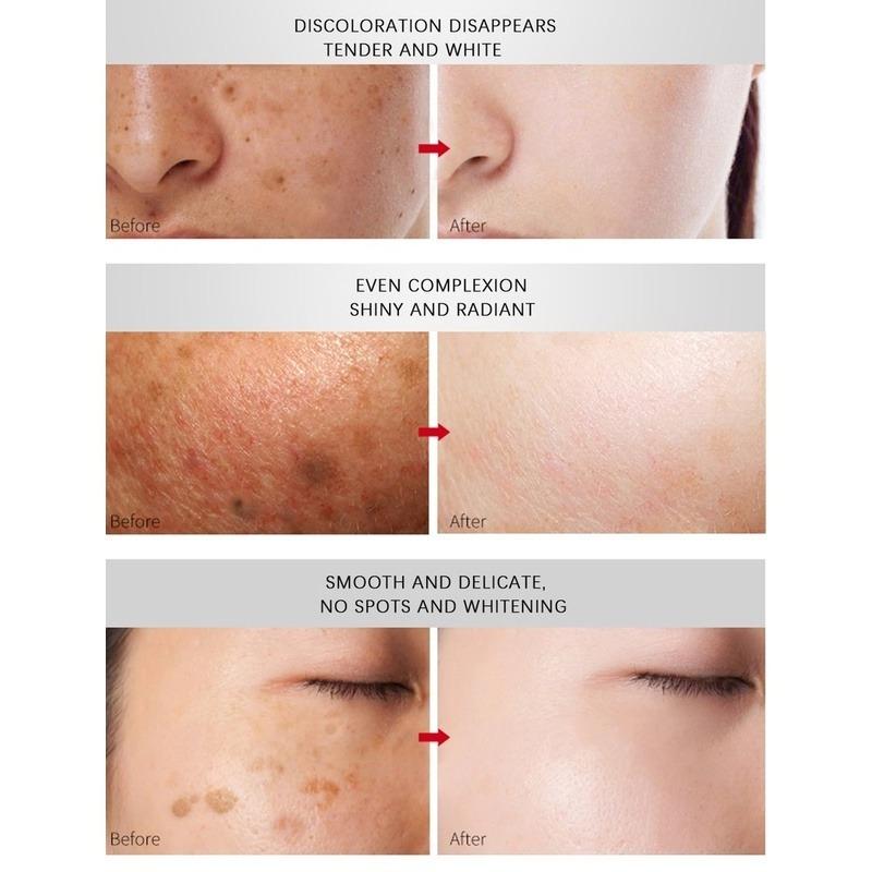 Отбеливающий крем, исчезающие пятна, черные точки, меланин, увлажняющий, осветляющий, мягкий, гладкий, укрепляющий, уход за кожей