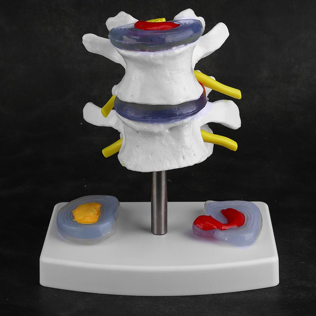 Анатомическая демонстрационная модель поясничной грыжи позвоночника человека, школьные учебные принадлежности