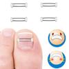 Ingrown Toenail Corrector Tools Pedicure Recover Embed Toe Nail Treatment Professional Ingrown Toenail Straightening Clip Brace