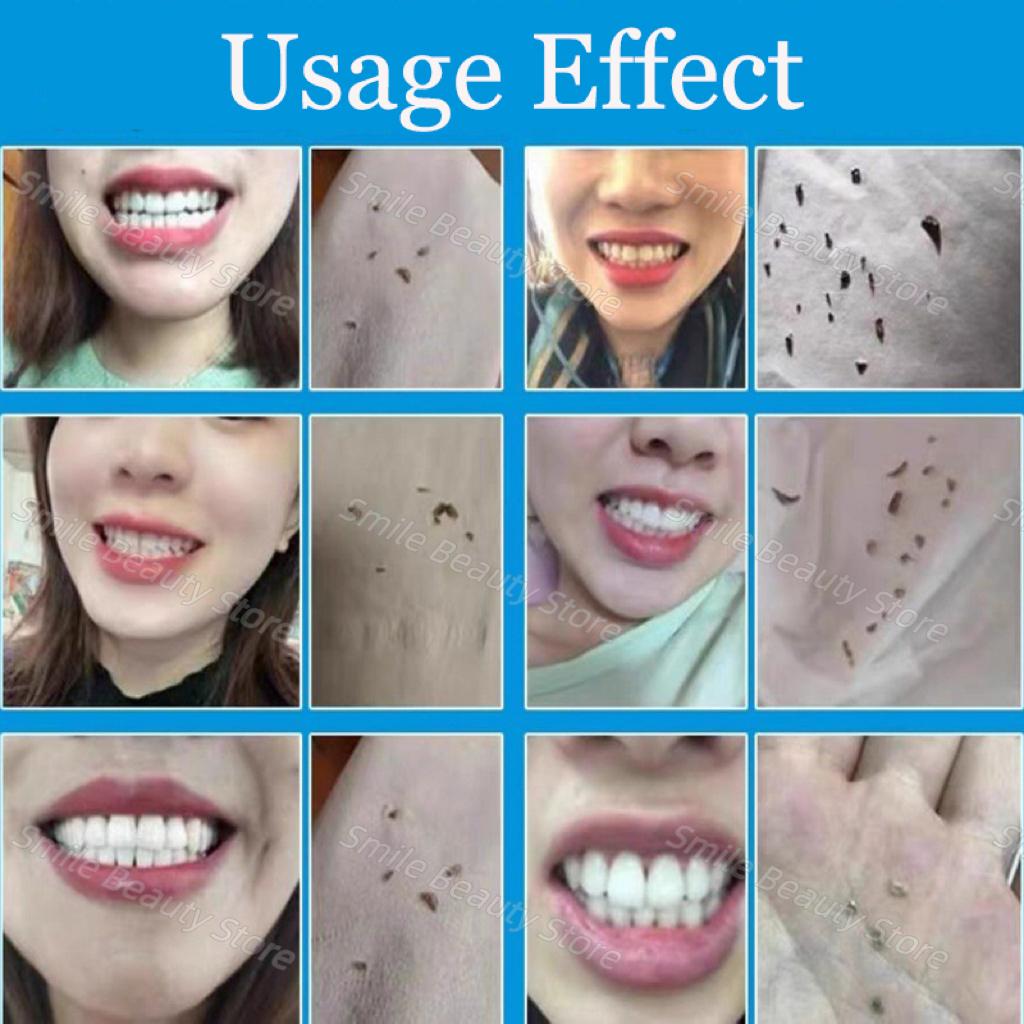 Спрей для удаления зубного камня для отбеливания зубов и удаления зубного налета