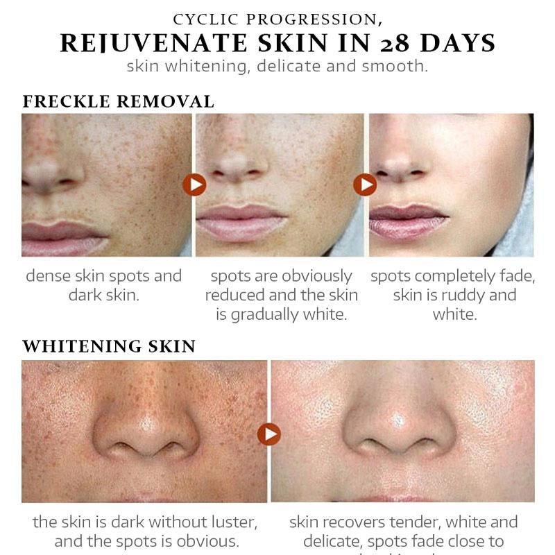 Отбеливающий крем для лица от веснушек, крем для удаления мелазмы, темных пятен, меланин, никотинамид, увлажняющий, осветляющий уход за кожей