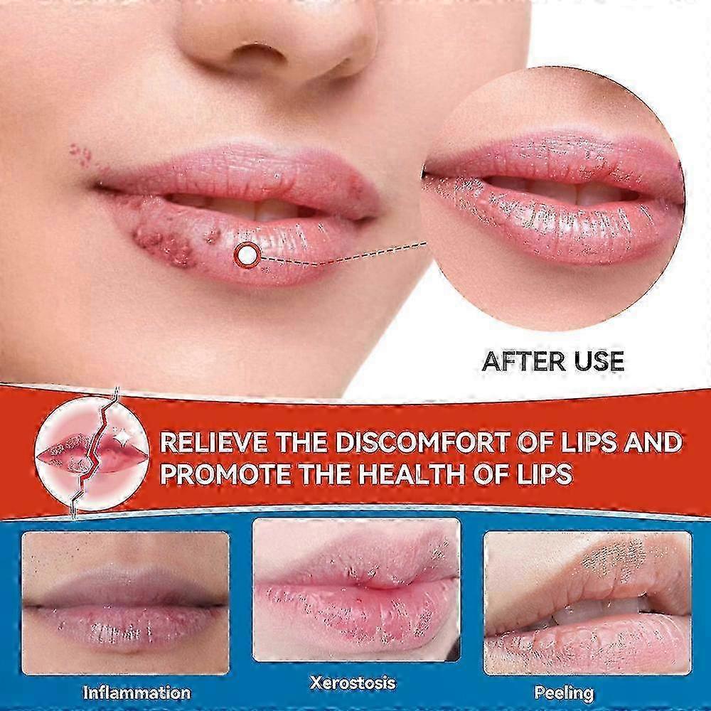 1-5X Intensive Lip Care Cream 20g - Immediate Soothe for Dry, Cracked, Peeling & Bleeding Lips JH7