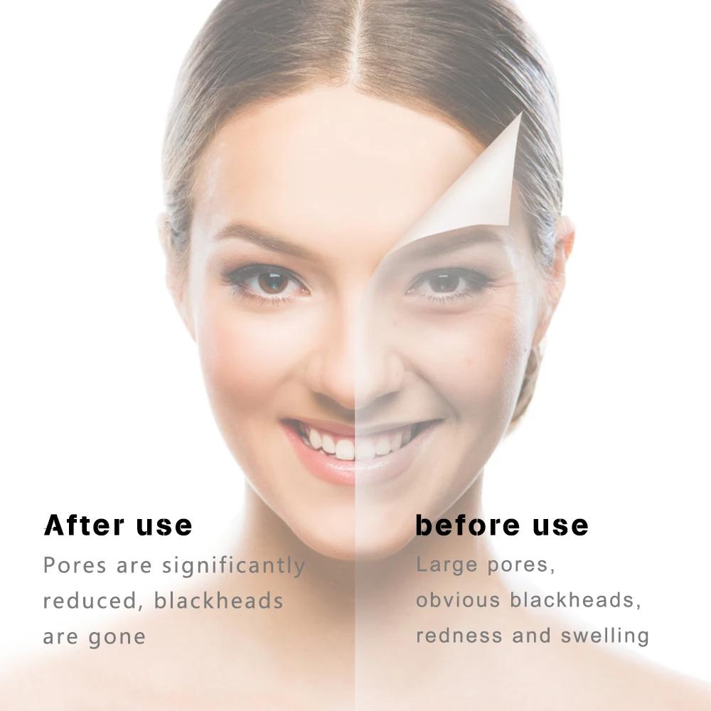 Косметологический прибор 6 насадок вакуумный очиститель пор для лица. Инструмент для очистки пор и черных точек. Инструмент для очищения и отшелушивания лица