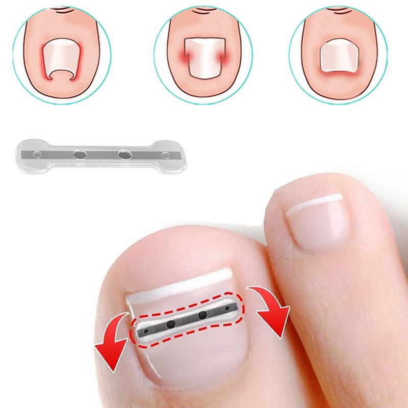 Инструмент для коррекции вросшего ногтя Эластичный пластырь для лечения вросшего ногтя Наклейка для выпрямления Зажим для скоб Инструмент для педикюра