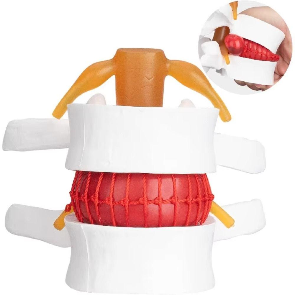 3D Model Human Anatomy Skeleton Model Lumbar Disc Herniation Teaching Tool Nursing