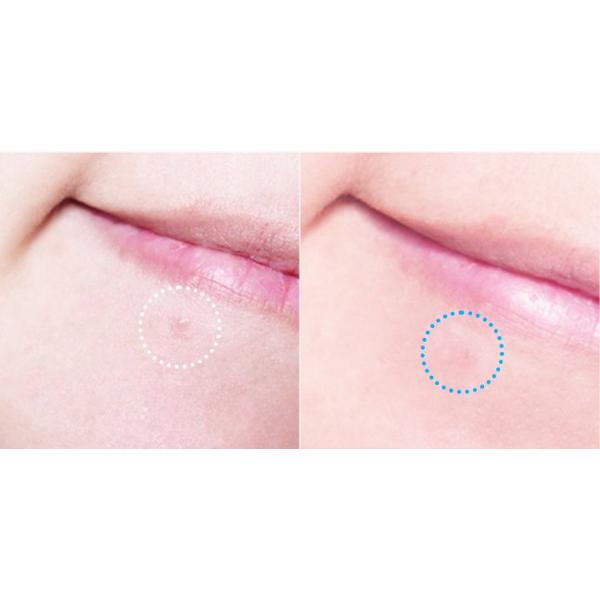 HATHERINE Spot Care Patch Kit (2 Types Spot Patch Duo) 76 Patches