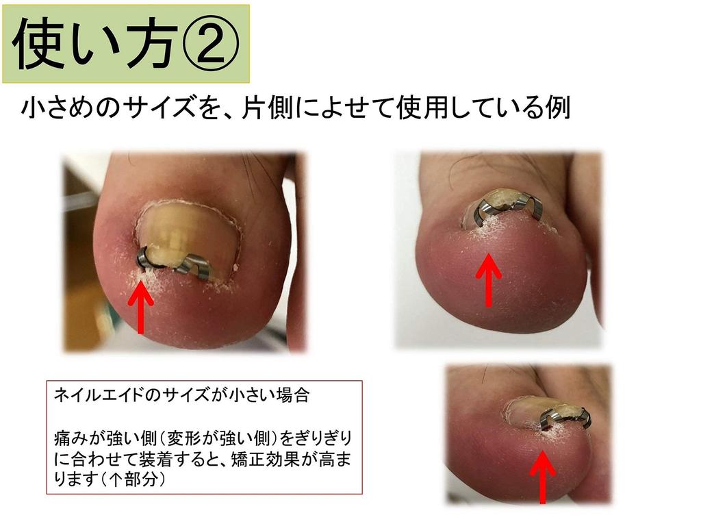 Nail Aid 16 мм Коррекция вросшего ногтя Сделай сам Проволочный зажим