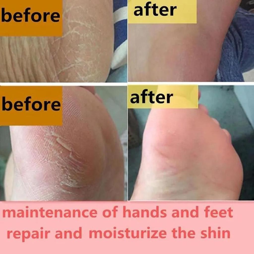 Gentle and Non-irritating, the Chapped Foot Repair Cream Hydrates and Nourishes the Skin, Leaving It Soft and Delicate