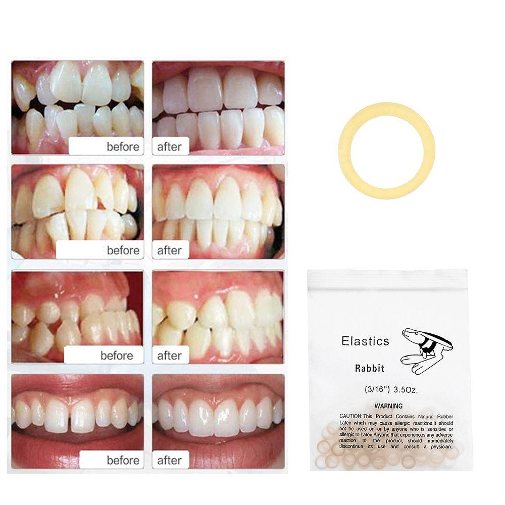 Коррекция промежутка между зубами Уход за полостью рта Эластики Ортодонтические кольца Резиновые латексные кольца Стоматологические резиновые ленты