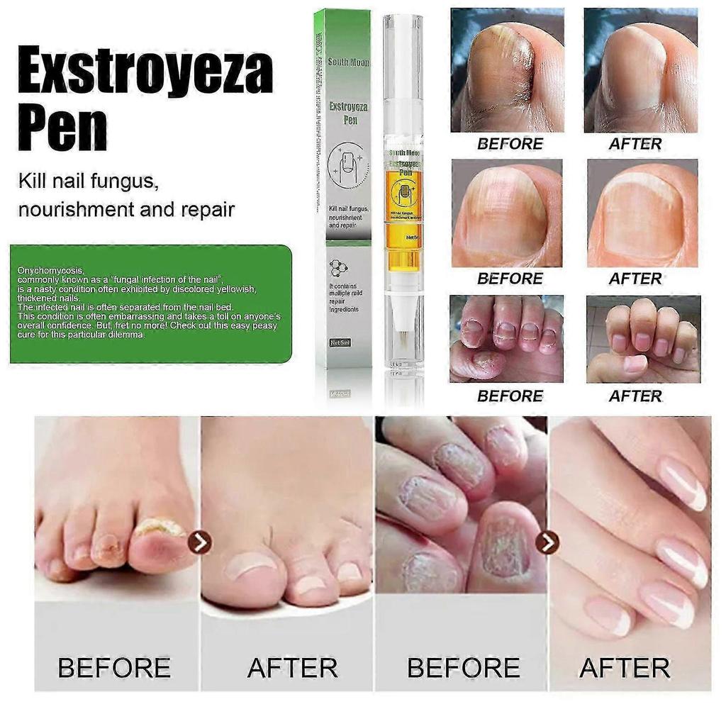 Exstroyeza Ручка-восстановитель для ногтей - Лечение грибка и питательный раствор для здоровых, чистых ногтей на руках и ногах - 5 мл Портативный уход за ногтями для бактериального In