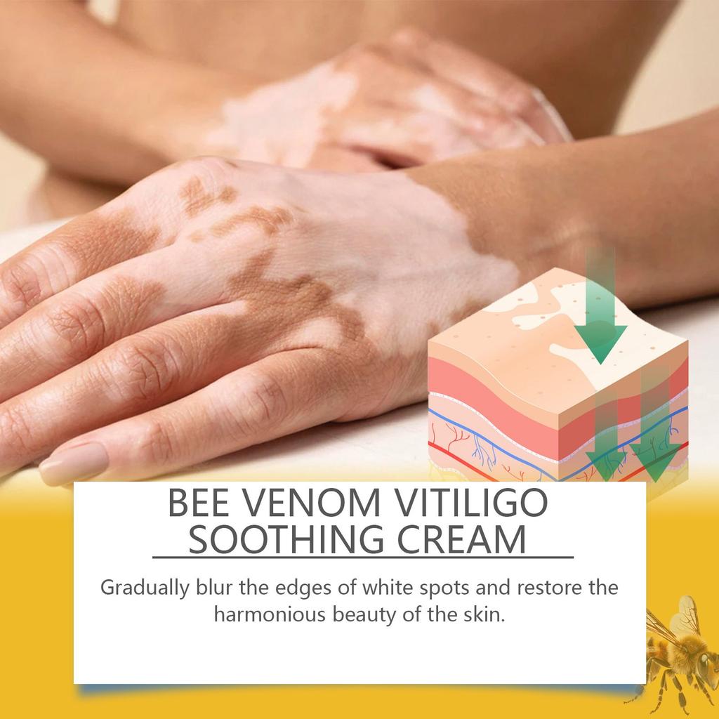 Vitiligo Relief Cream, Skin Care Cream, Vitiligo Cream, Improves Dryness, Suitable For All Skin Types