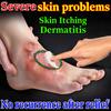 Natural Dermatitis & Eczema Cream - Herbal Blen Soothes Itching Gentle On Sensitive Skin