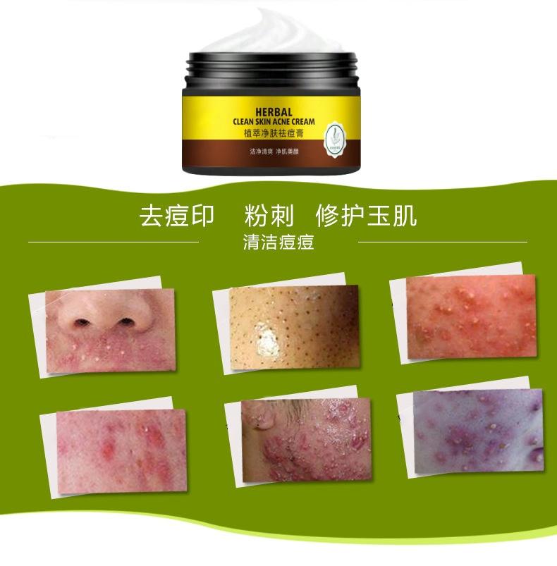 Acne Removing and Acne Removing Acne Repair and Desalination of Acne Print Cream